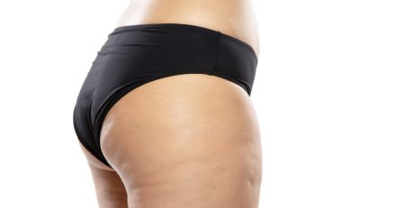 combatir la celulitis