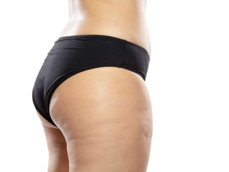 combatir la celulitis