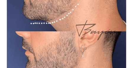 rellenos acido hialuronico madrid