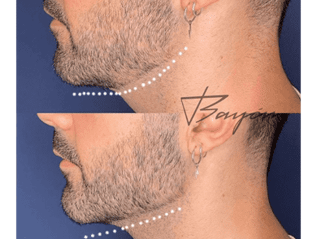 rellenos acido hialuronico madrid