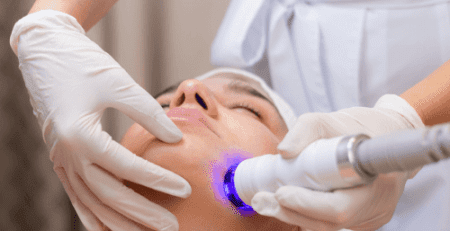 ipl facial madrid
