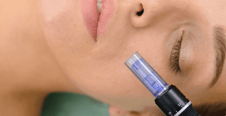 dermapen facial madrid