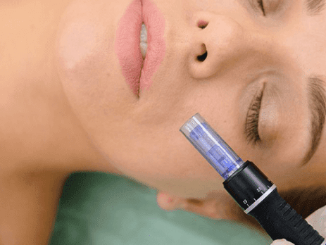 dermapen facial madrid