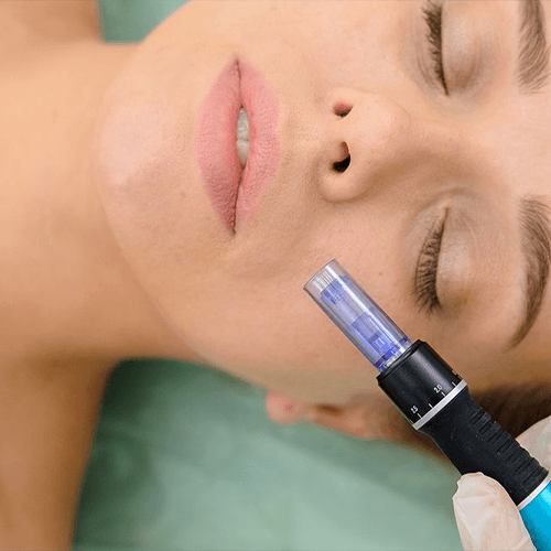 dermapen facial madrid