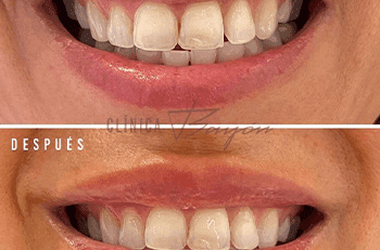 sonrisa gingival madrid