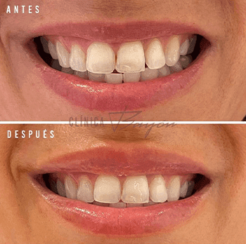 sonrisa gingival madrid
