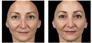 polinucleotidos clinica bayon madrid