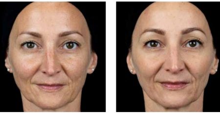 polinucleotidos clinica bayon madrid