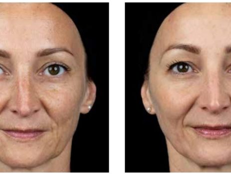 polinucleotidos clinica bayon madrid